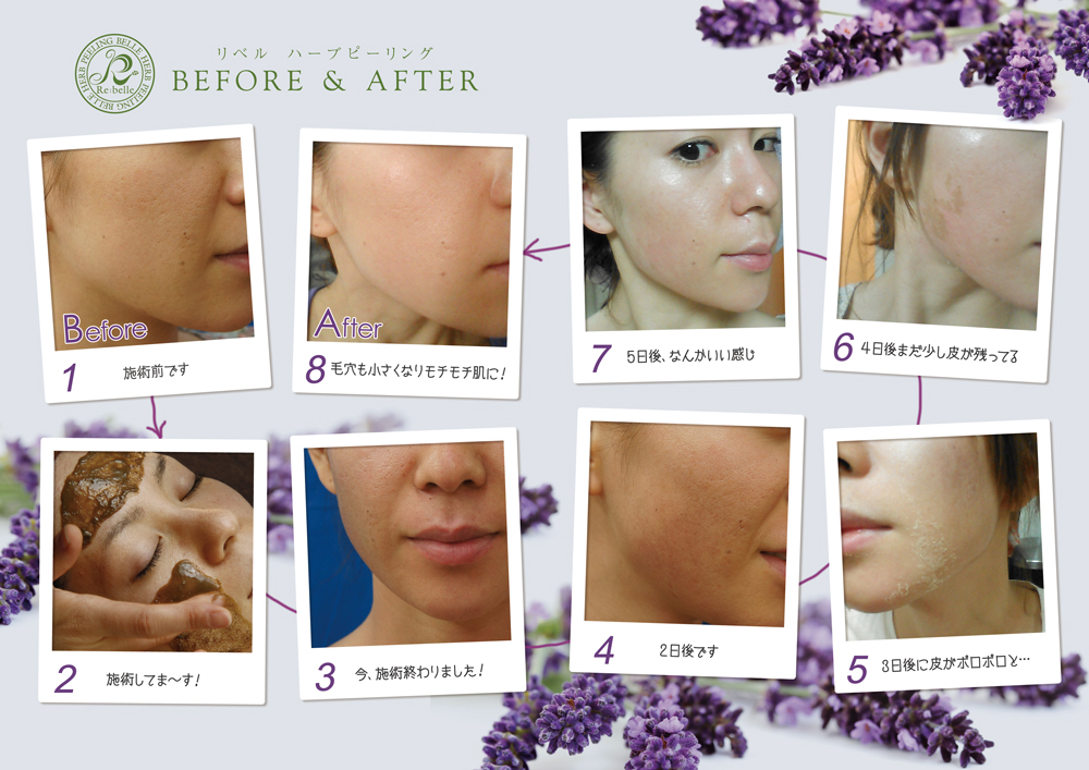リベルハーブピーリング　ビフォアアプター