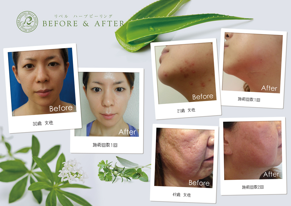リベルハーブピーリング　ビフォアアプター